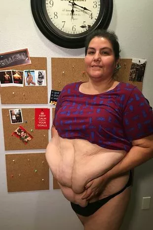 Mum has 17lb flap of saggy SKIN removed from stomach after shedding half her bodyweight for wedding