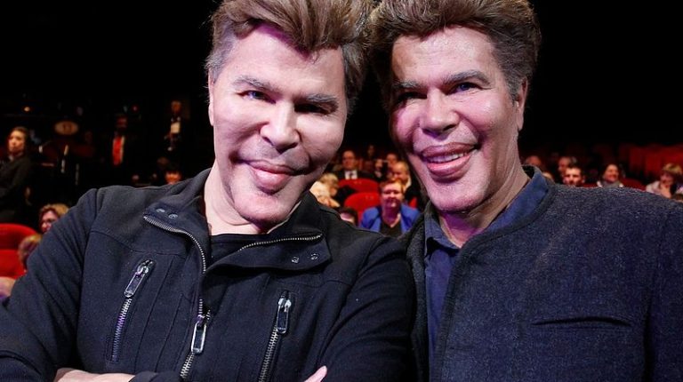 🤯Due to numerous plastic surgeries, these brothers have severely altered their appearance. 😓What did they look like before?