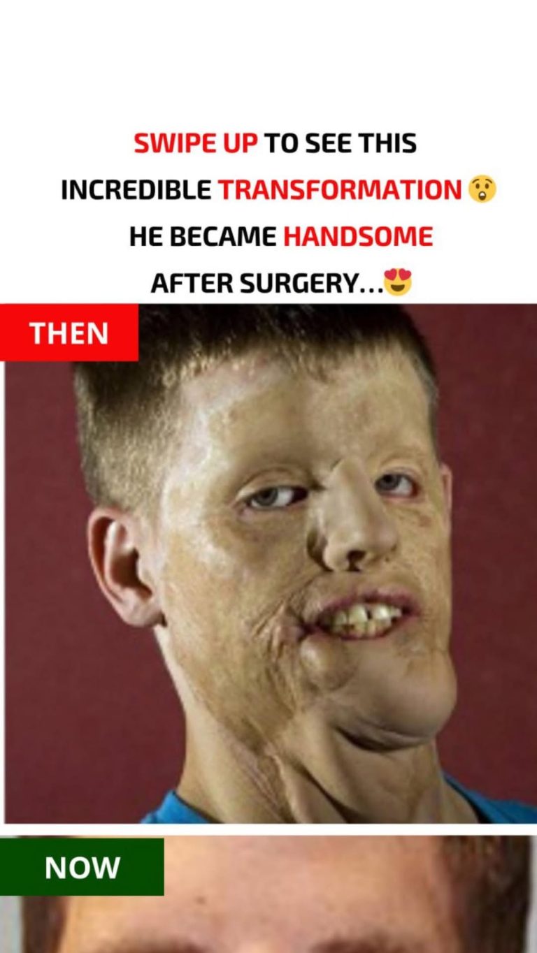 The United States has seen its second full-face transplant with Mitch Hunter… See the result below…
