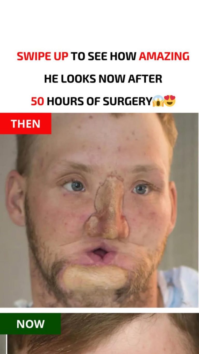 Face transplant patient overjoyed with his brand new appearance… Look how amazing he looks now…