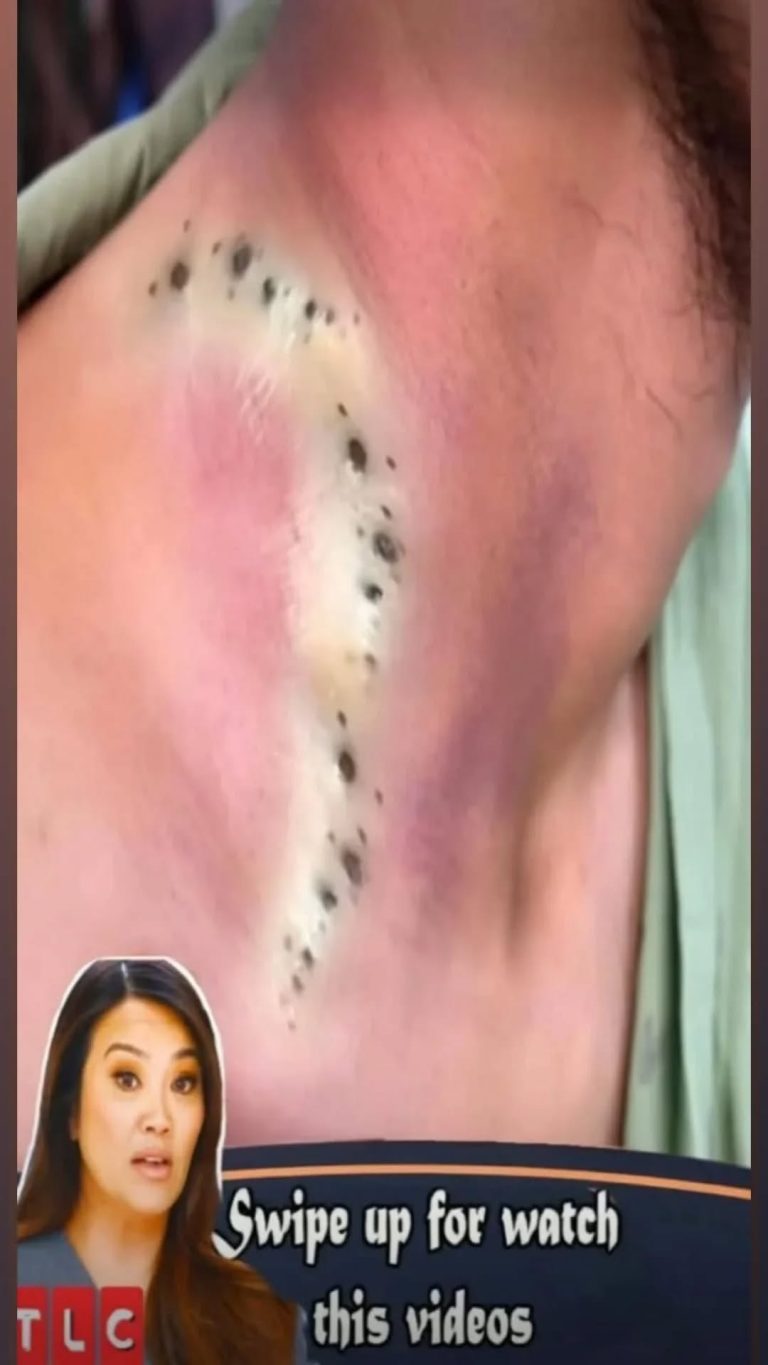 Blackheads – Pimple