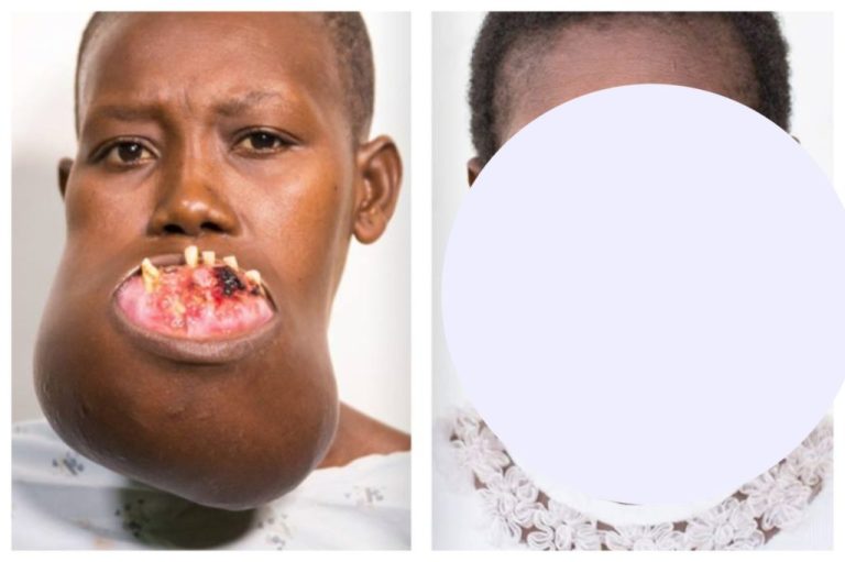 This girl has become a real beauty after the facial surgery… See the result…