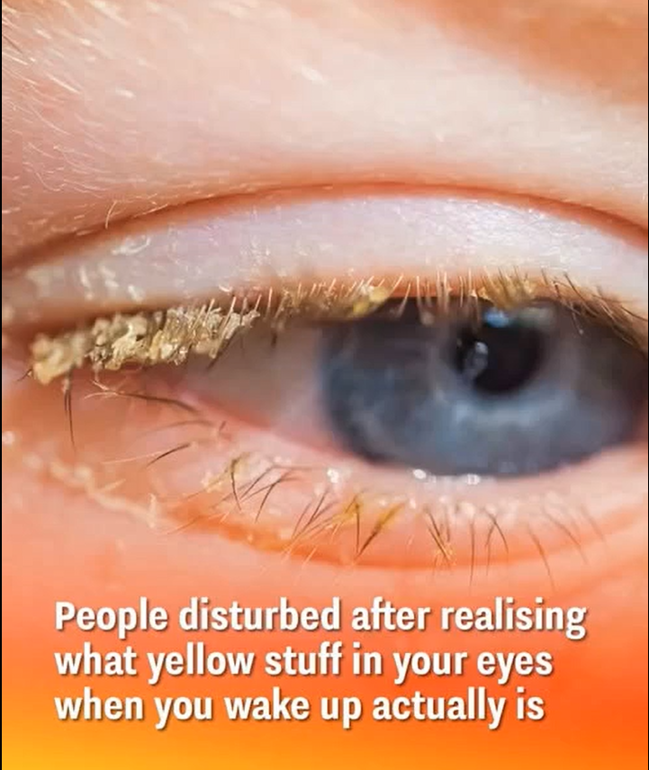 Why You Wake Up with Gunk in Your Eyes