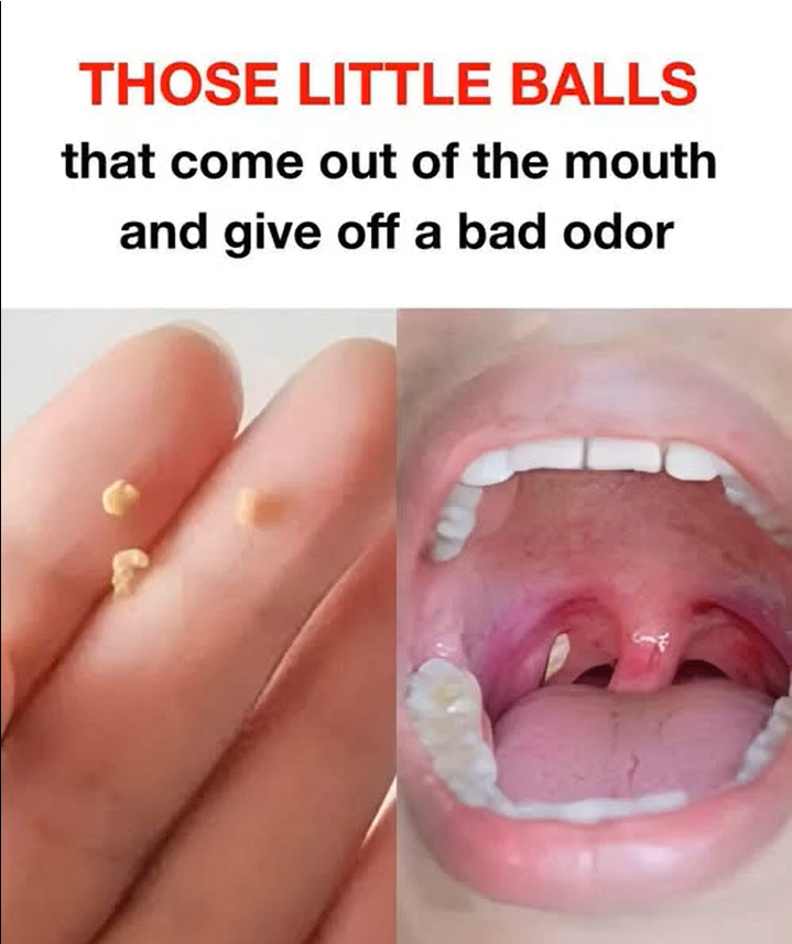 Understanding Tonsil Stones: Causes of the Smell and Effective Ways to Treat Them