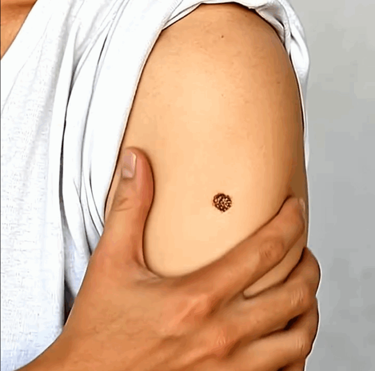 The Real Reason Many People Have a Scar on Their Upper Left Arm